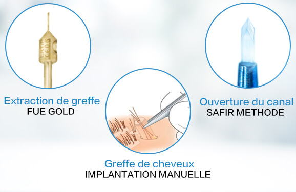 Haartransplantation
