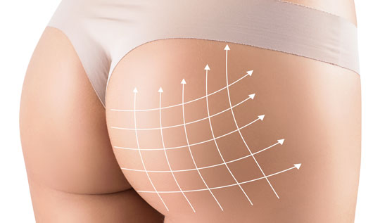 Lipofilling Fessier en Turquie