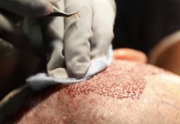 Greffe de Cheveux Fue