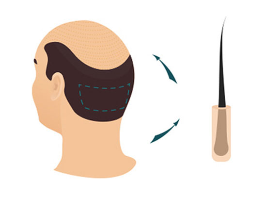 Greffe de Cheveux FUE Méthodes