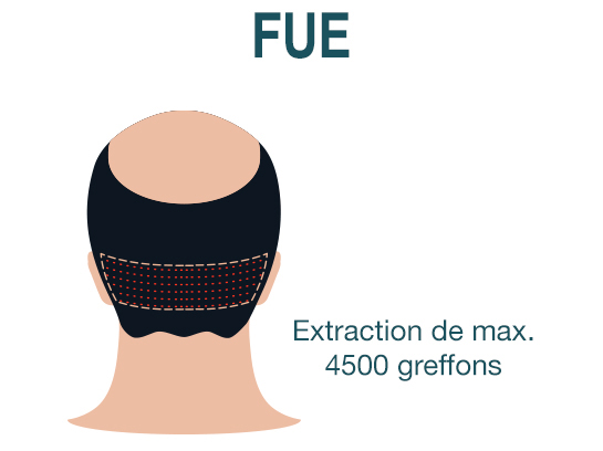 Greffe de Cheveux FUE Turquie