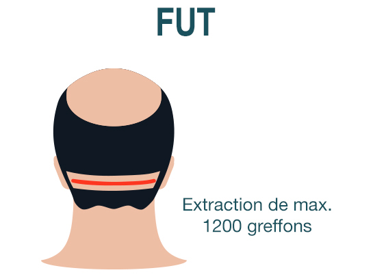 Greffe de Cheveux FUT Turquie