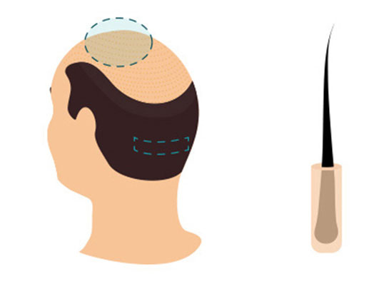 Greffe de Cheveux FUT Turquie