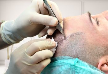 Greffe de Cheveux implantation manuel