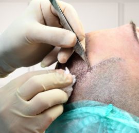 Greffe de Cheveux Manuel