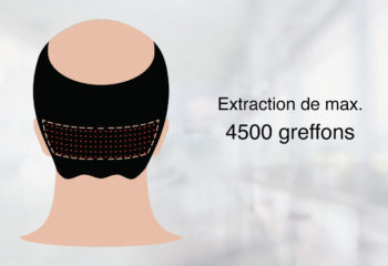 Greffe de Cheveux Méthode FUE