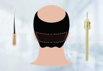 Greffe de Cheveux FUE Gold