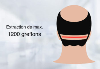 Greffe de Cheveux FUT Méthode