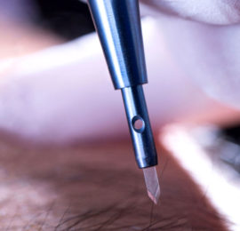 Greffe de Cheveux Saphir Méthode