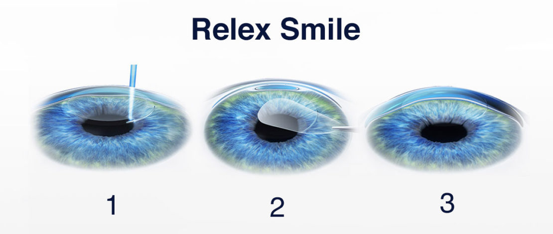 Relex Smile Méthode