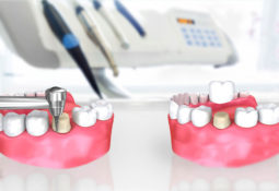 Implant Dentaire Turquie Implant Dentaire Turquie