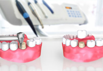 Implant Dentaire Turquie