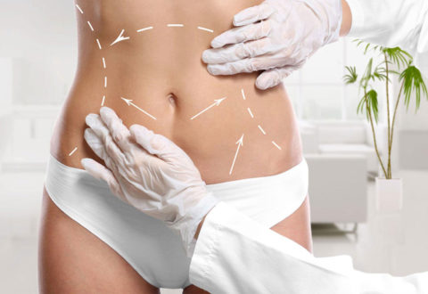 Liposuccion istanbul