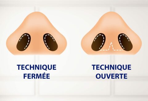 Technique Fermée Technique Ouverte