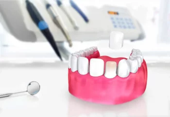 Non prep Veneers Turquie Non prep Veneers Turquie