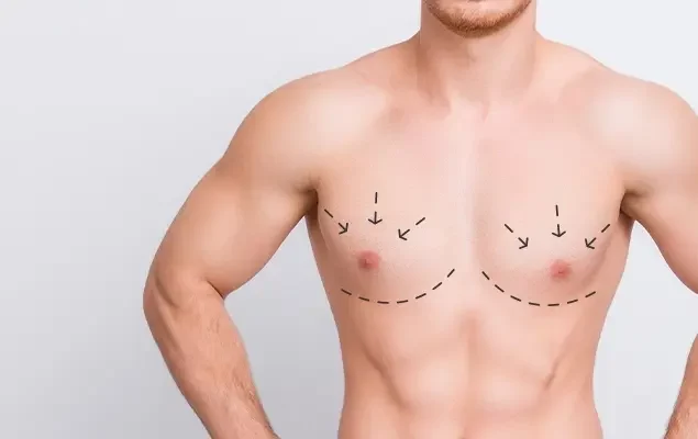 Greffe-de-cheveux-et-Chirurgie-de-la-gynecomastie