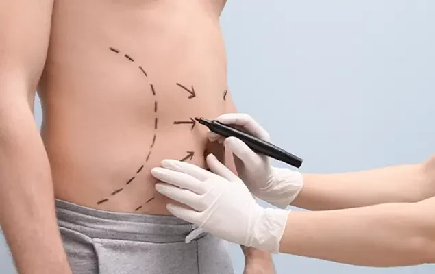 Greffe-de-cheveux-et-liposuccion