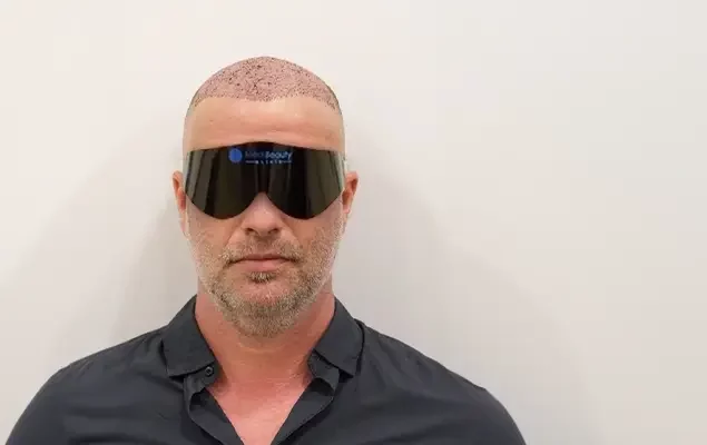 greffe-de-cheveux-et-traitement-des-yeux-laser